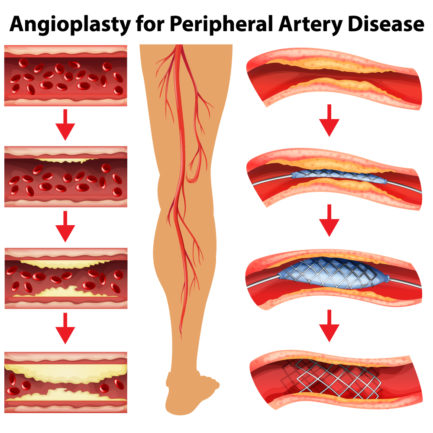 Angioplasty for Peripheral Artery Disease