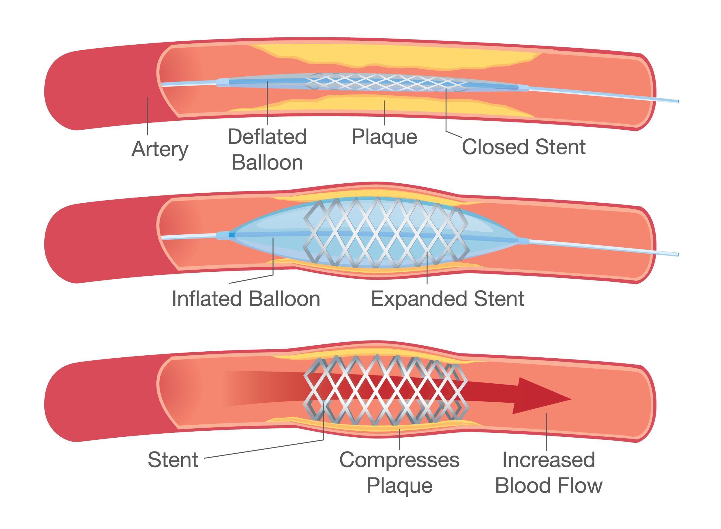 PCI Stent is inserted to increase blood flow