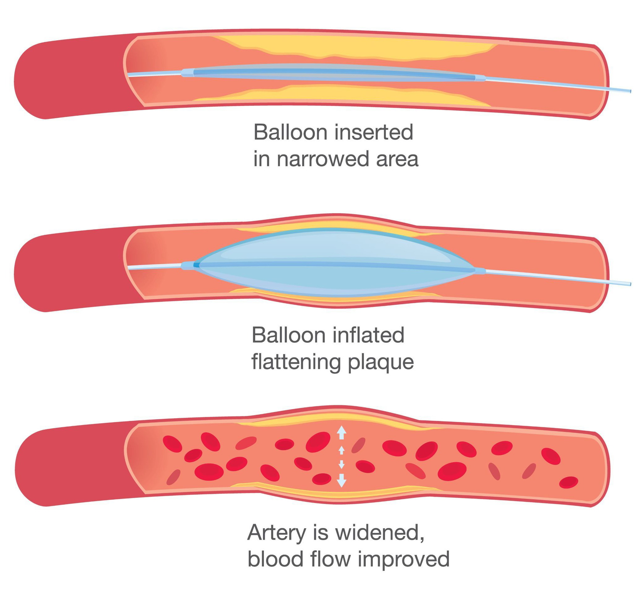 Balloon inserted in narrow area, inflated flattening plaque, artery is widened, blood flow improved